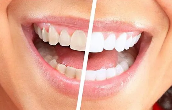 جهاز Luma Smile Tooth Polisher Whitener لتبييض الاسنان